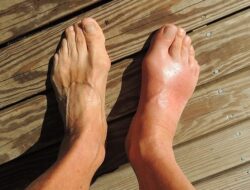 Diantaranya Talas, 5 Cemilan Ini Ternyata Bisa Turunkan Asam Urat